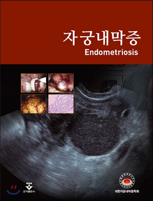 자궁내막증 = Endometriosis