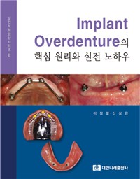 Implant overdenture의 핵심 원리와 실전 노하우